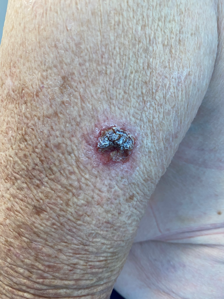 Carcinoma espinocelular Academia Dermatoscópica